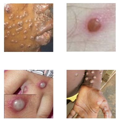 Monkeypox Example