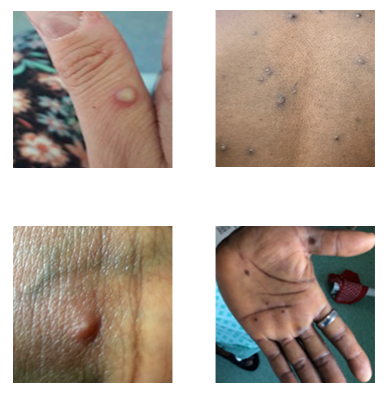 Monkeypox: What You Need to Know